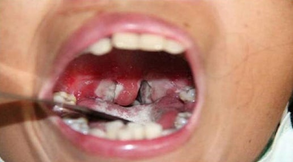 td vaccine launch cri kasauli tetanus diphtheria